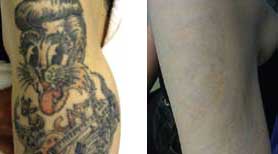 tetovalas eltavolitasa lezerrel 3