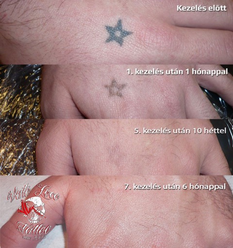 kezfej tetovalas eltavolitas lezerrel Csobay Nora Vato Loco Tattoo Laser Tattoo Removal