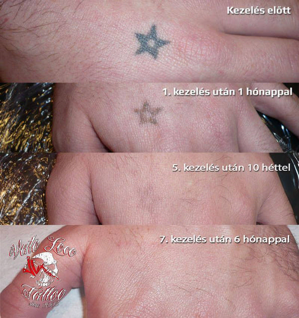 tetovalas eltavolitas lezerrel 2