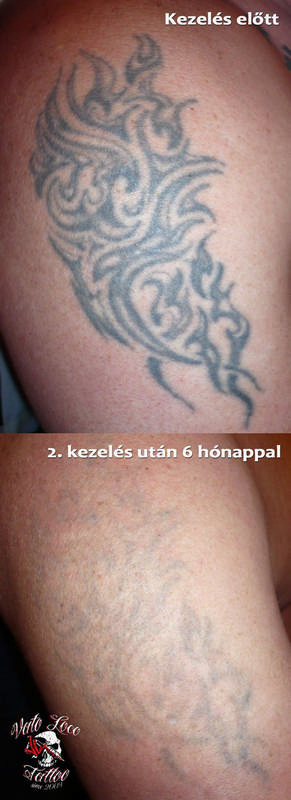 tetovalas eltavolitas lezerrel 5